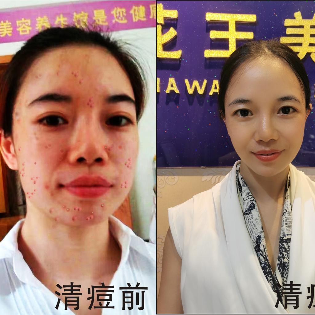 贵港战痘抗敏曦姐