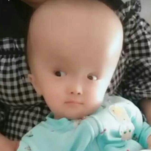 脑积水瑶瑶