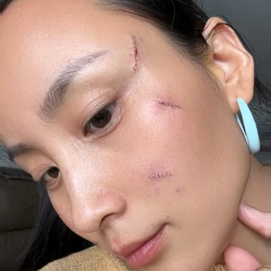 上海9院切疤的苏苏呀！