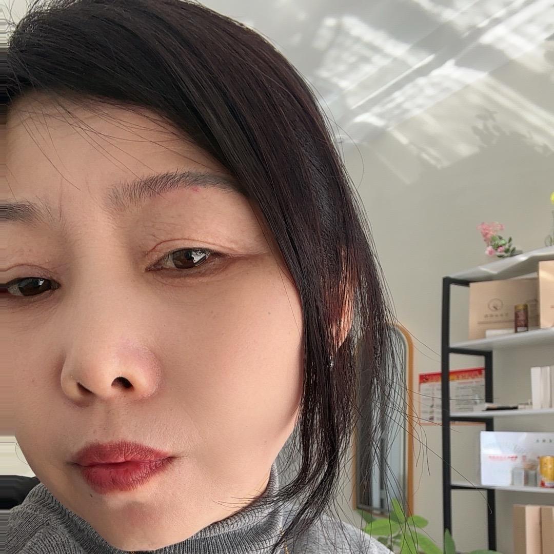 嘉兴免费祛斑一次掉（孔姐3）