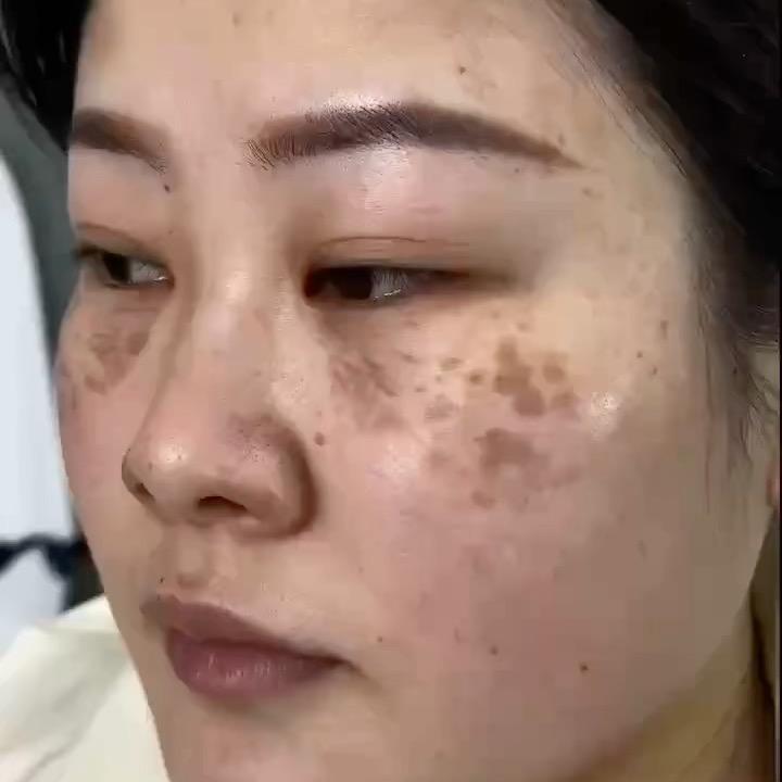 常州祛斑找慧慧