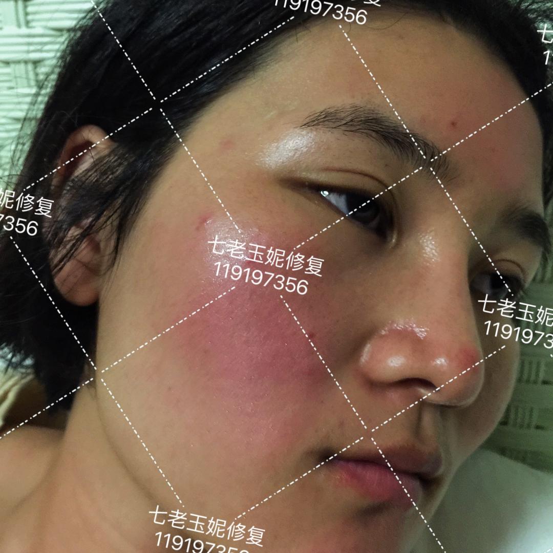 玉妮专注激素脸敏感肌直播号1