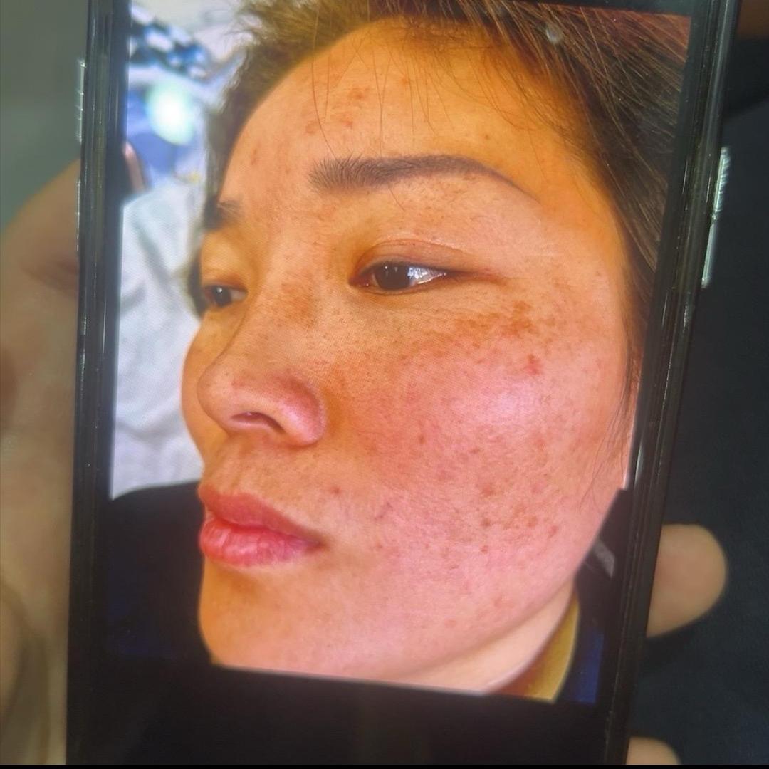 新沂静姐免费祛斑一次净