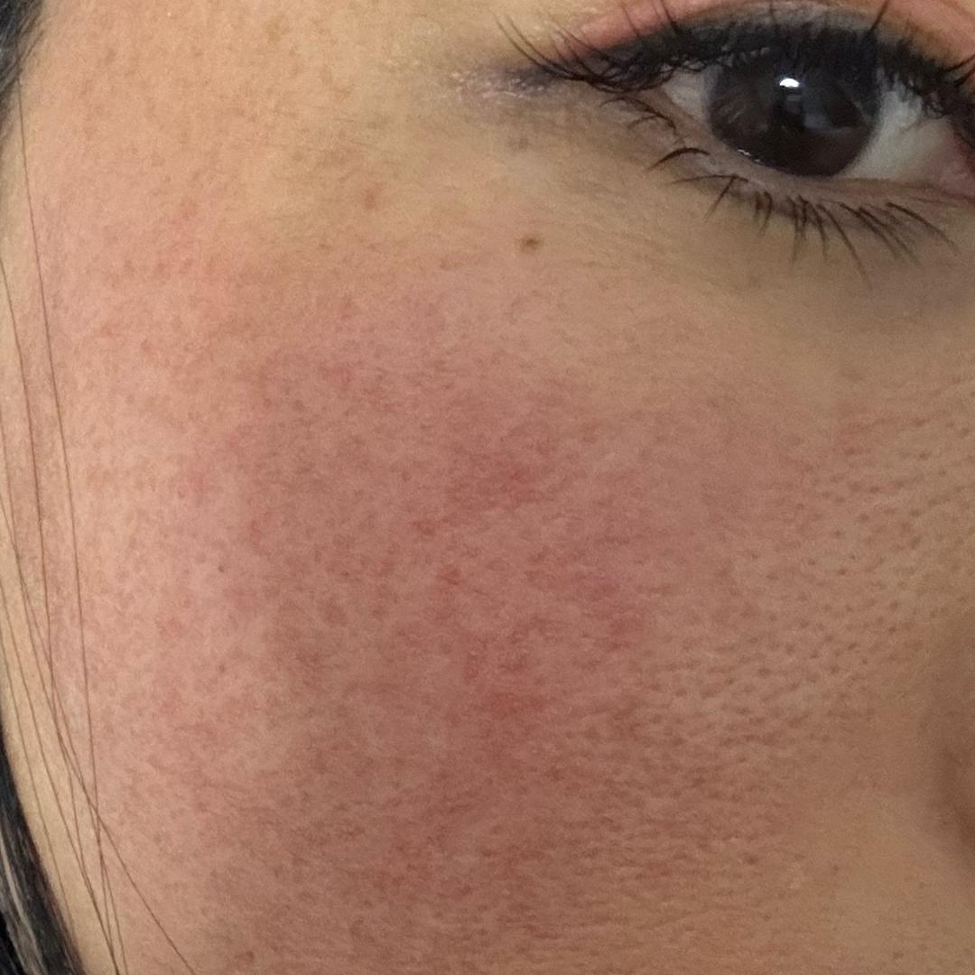 🎈玫瑰痤疮，患者