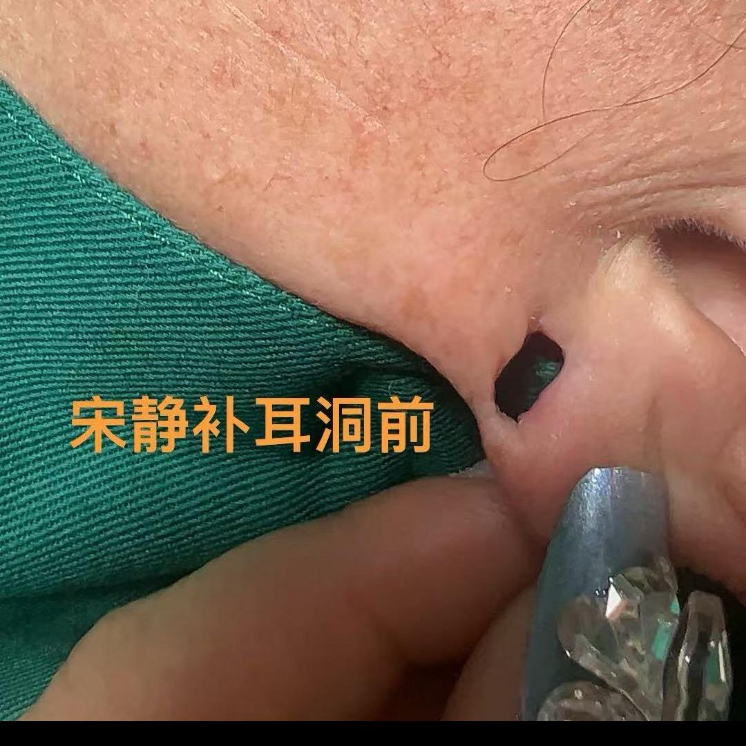 修复耳洞