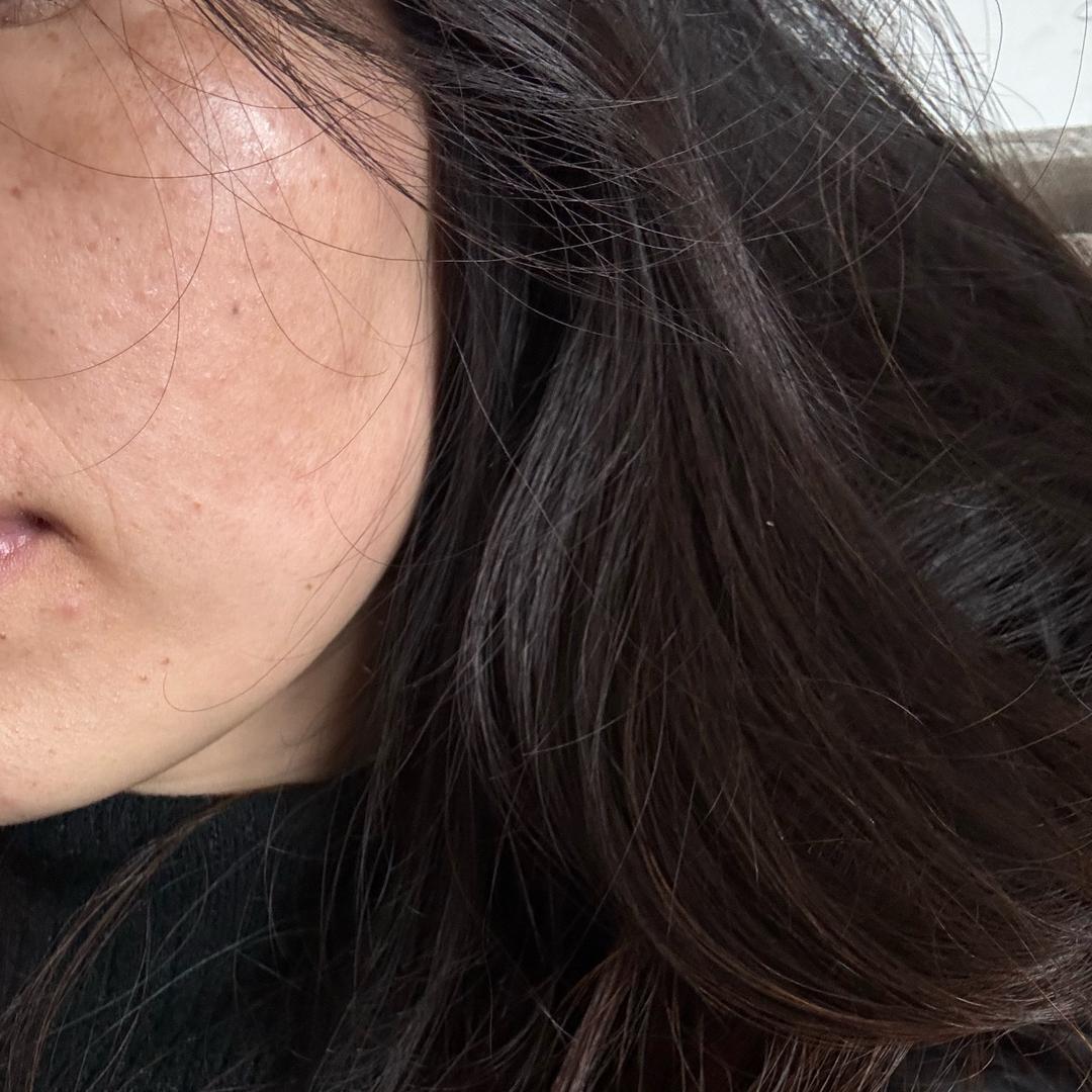 满脸的斑