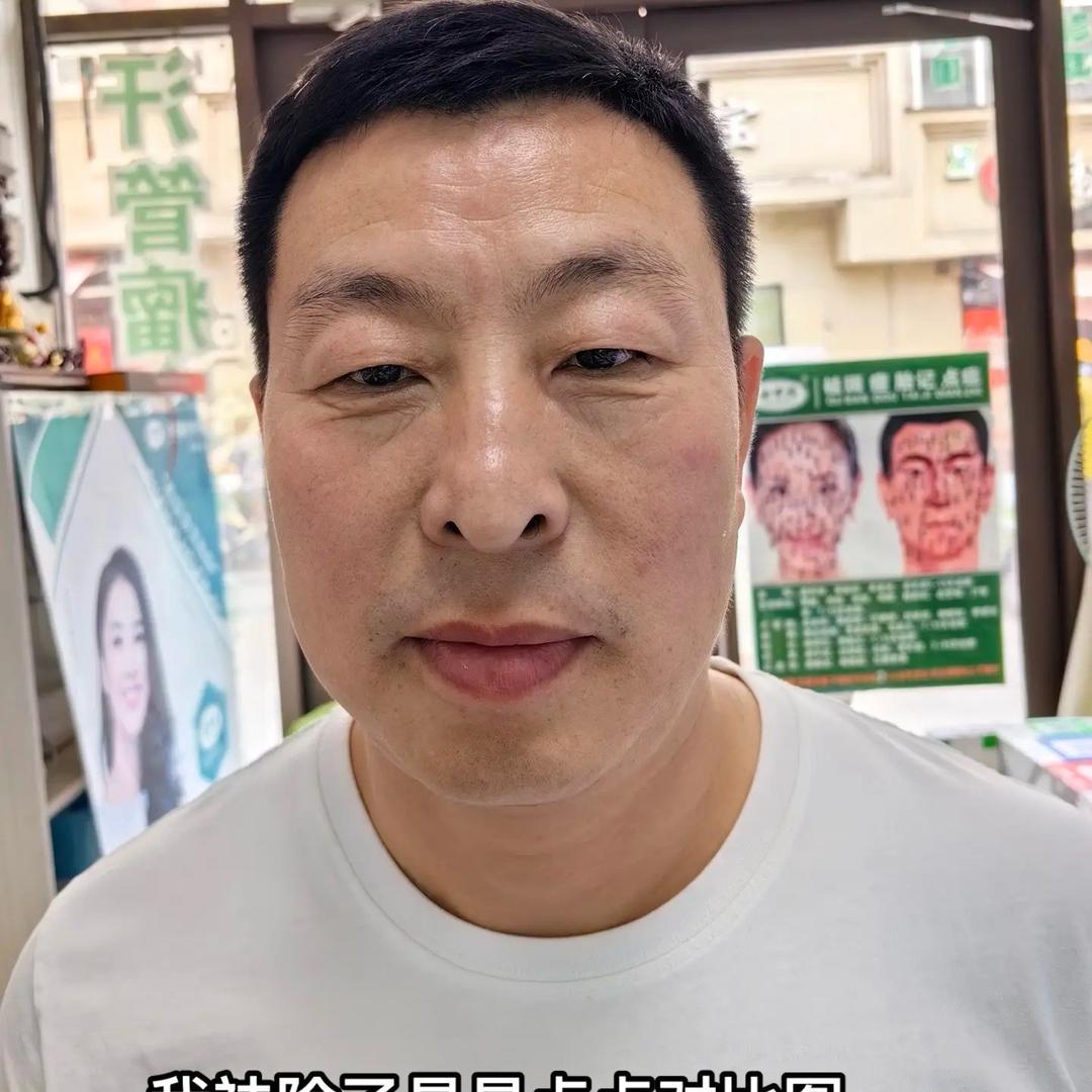 祛痣，祛斑，贾海峰，原百味居