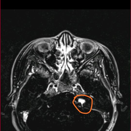颅底有个外星生物