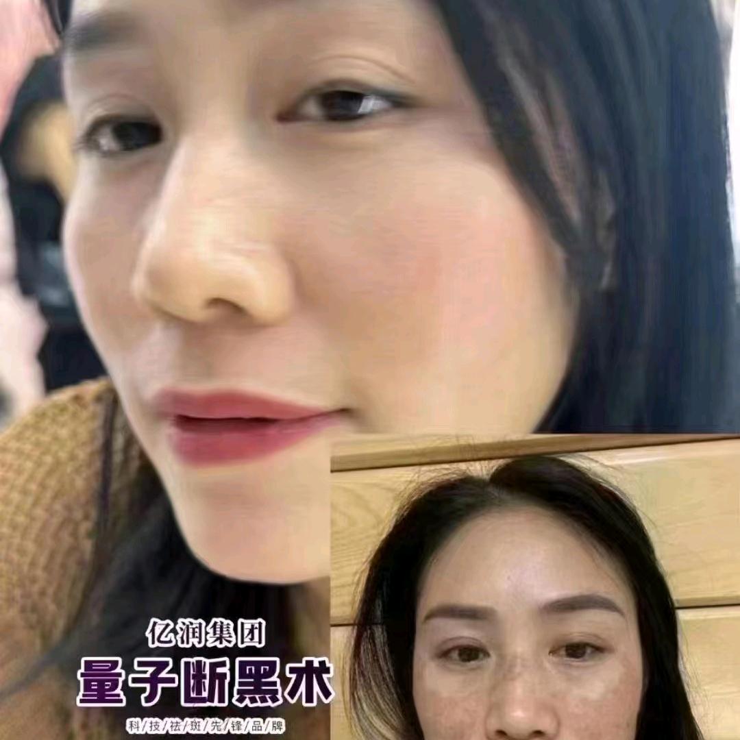 专业做斑的菲菲姐