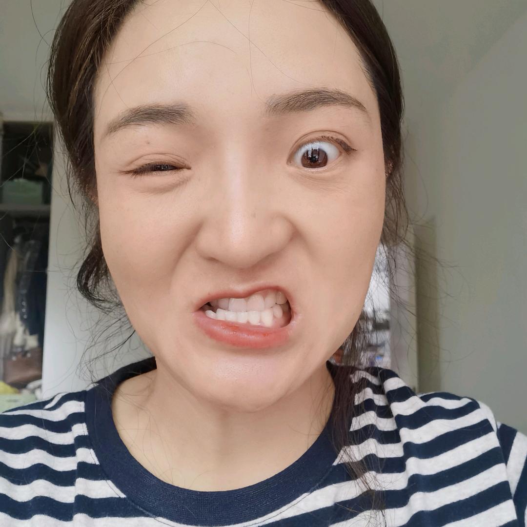小熙岛主（面瘫后遗症）