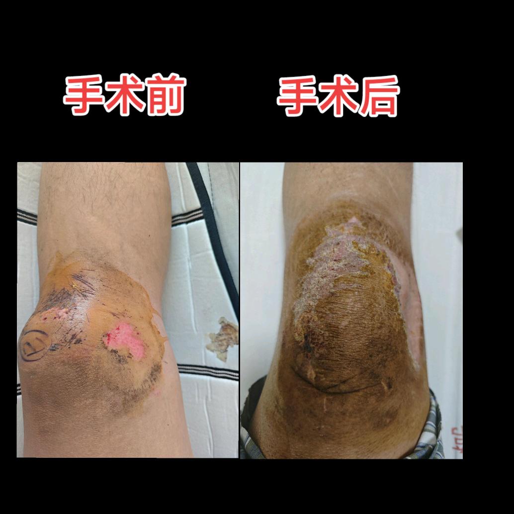 在九院做的髌骨内固定术导致残疾