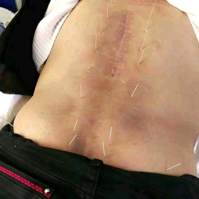 残疾人肋骨左右骨折17腰椎粉性骨折做手术