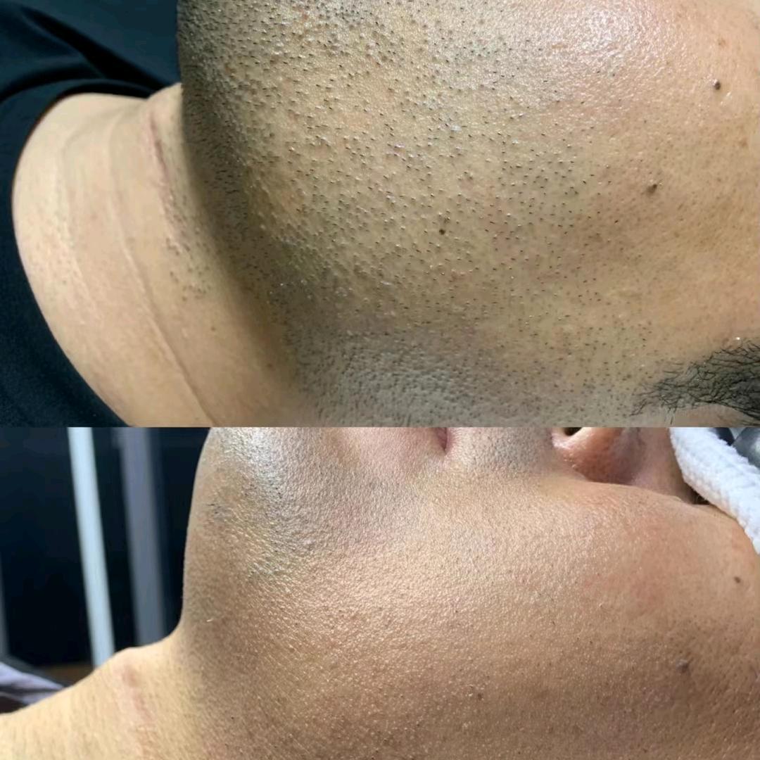 沈丘男士胡须根除