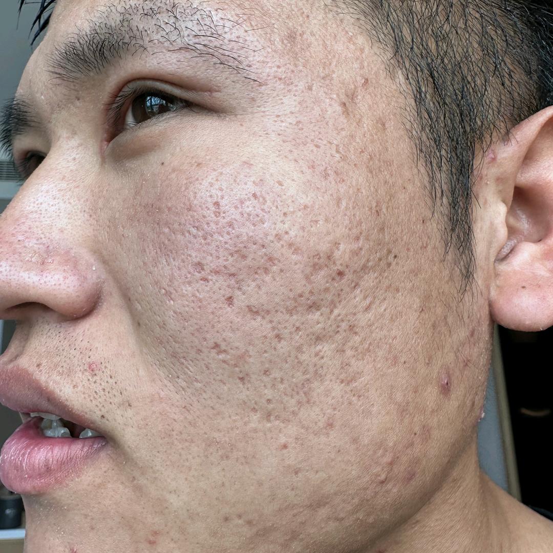 痘坑恢复中