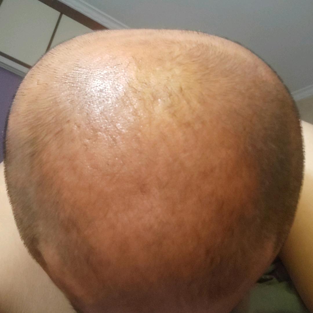 秃头斌哥养发记