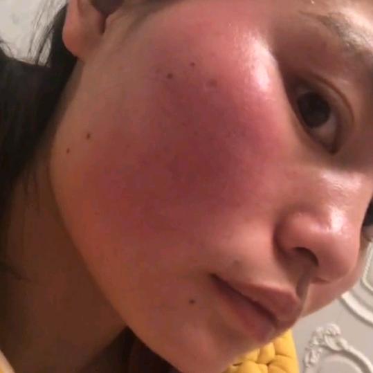 玫瑰的痛痛痛（屏障修复实战者）