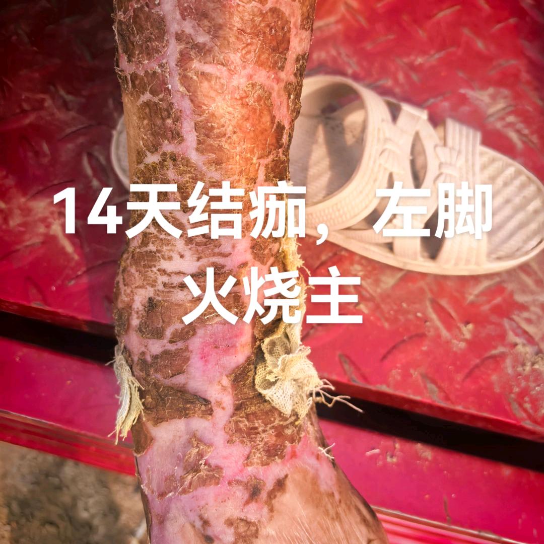 庆哥，常寺村烧伤科记录生活