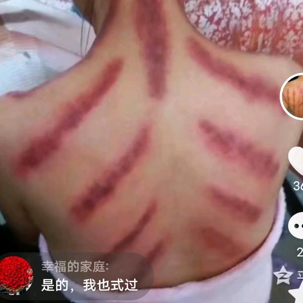 专业刮痧