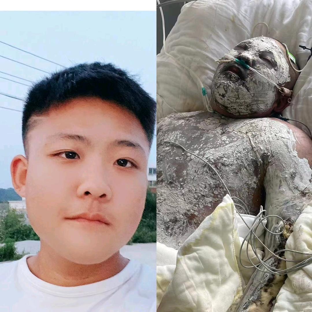 8.29乌金山摩托车失火受害人妈妈