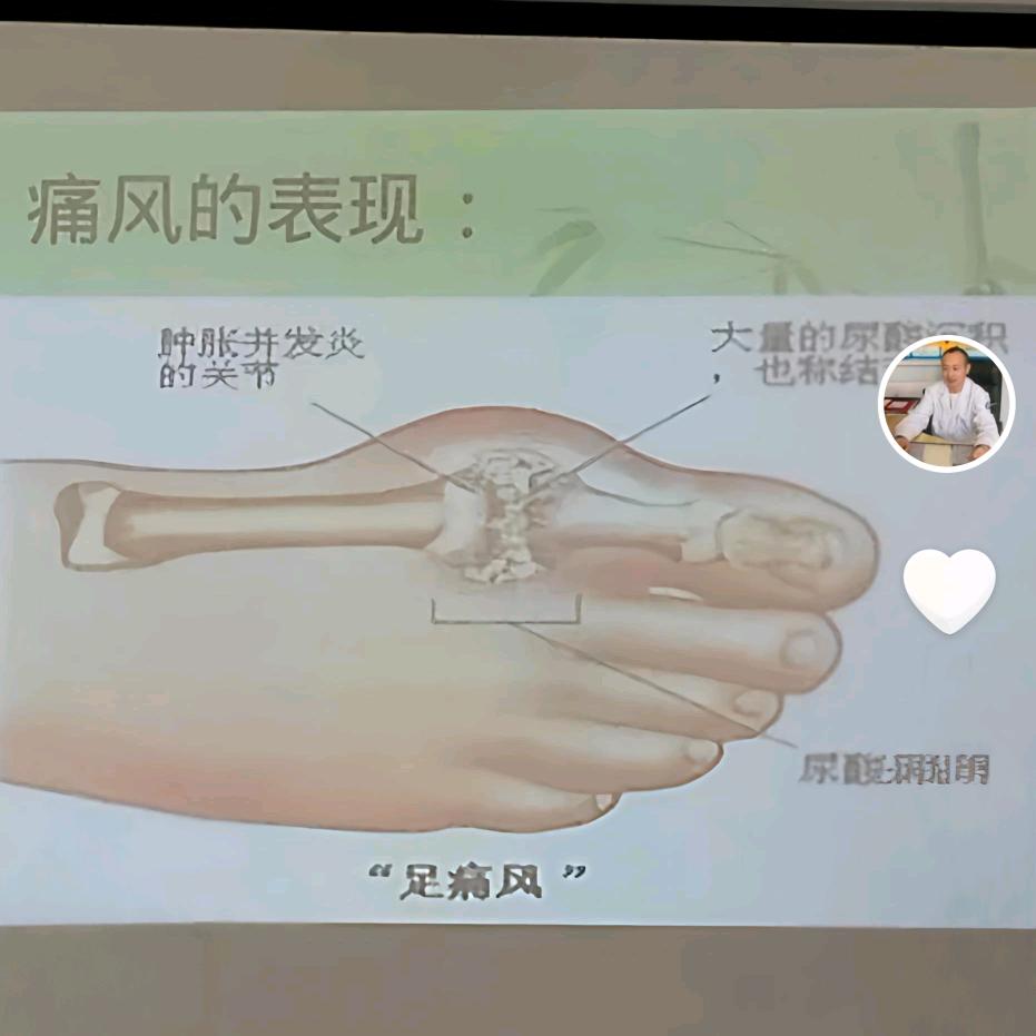 高碑店痛风小克星