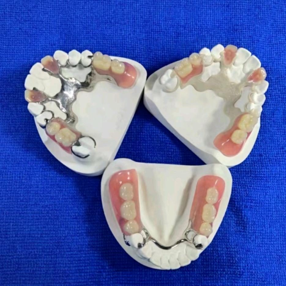 即刻负重吸附性义齿陈生