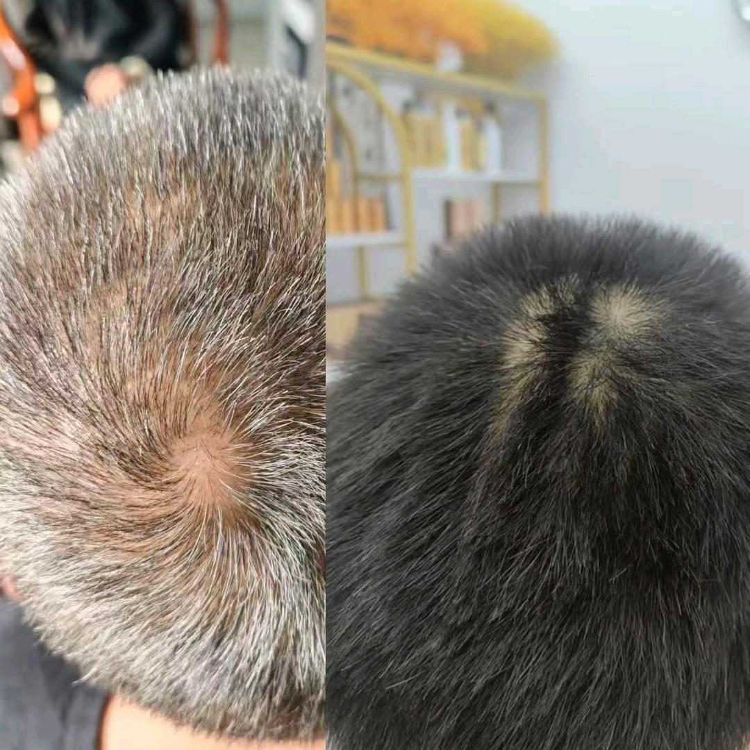 定远，专业做，白发，脱发，林老师