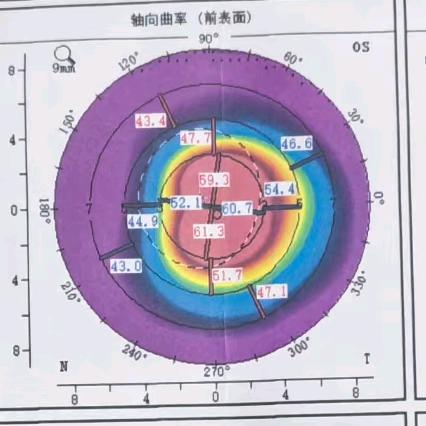 圆锥角膜/OK镜-硬镜护理20年