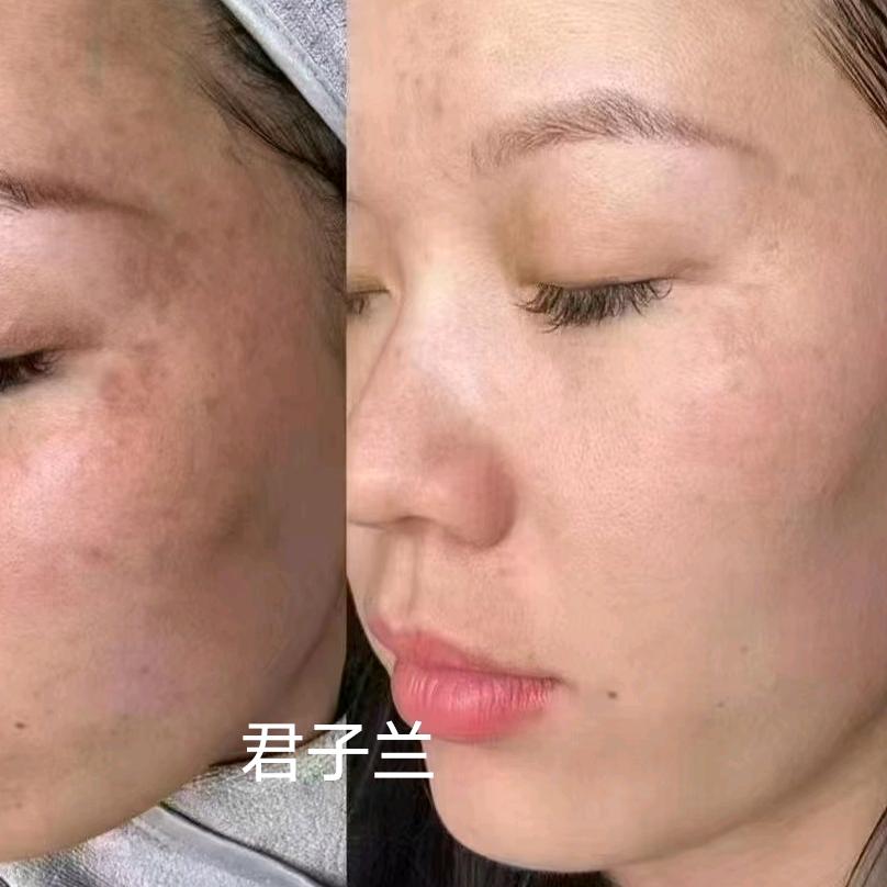 君子兰斑痘敏皱问题性肌肤终点站