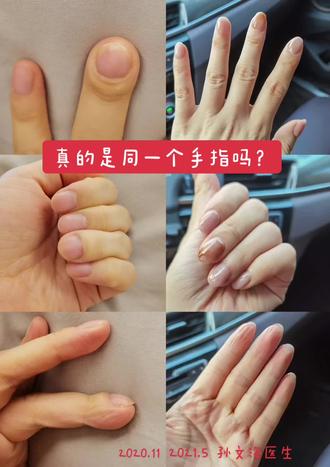 d型短指症典型形态系列之95#d型短指 #短粗拇指 #拇指延长 #短指